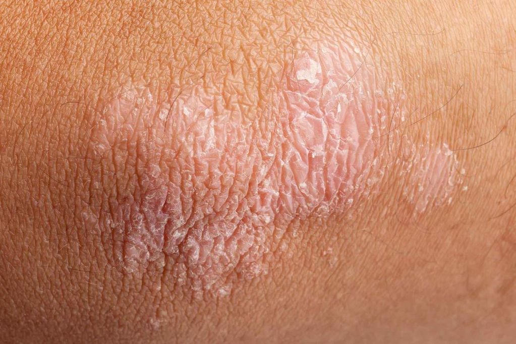La piel afectada por la psoriasis suele desprenderse en forma de escamas, lo que puede resultar en manchas blancas o plateadas en la ropa.