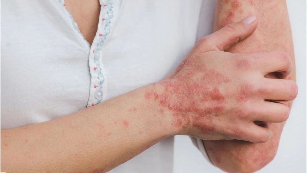 Placas rojas y elevadas en la piel es uno de los síntomas más comunes de la psoriasis. 