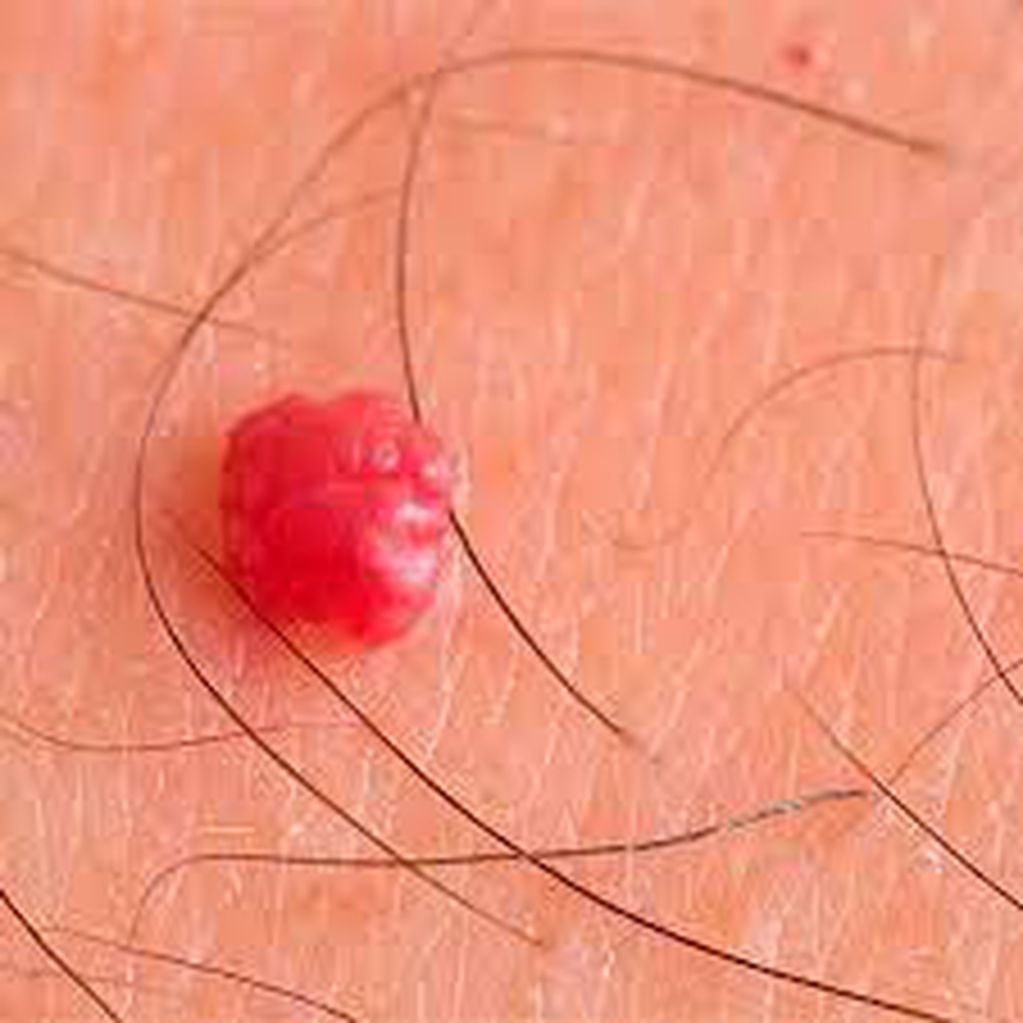 Los puntos rubí suelen ser inofensivos y no requieren de tratamiento a menos que causen molestias o se quieran eliminar por razones estéticas. 