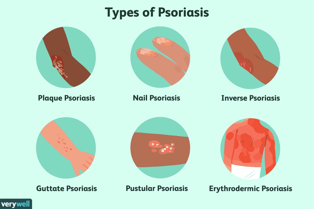 Si sospechas que podes tener psoriasis, te recomiendo que consultes a un dermatólogo para recibir un diagnóstico preciso y tratamiento adecuado.