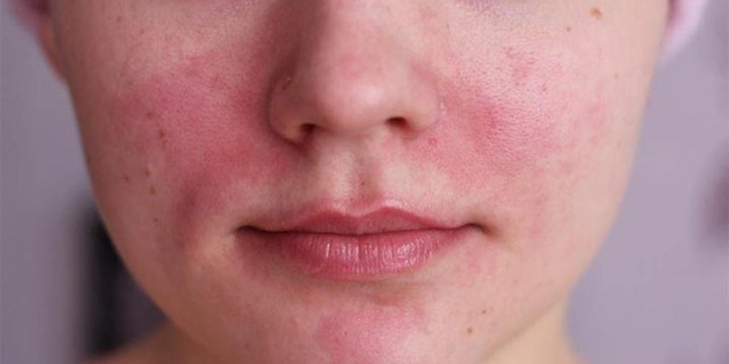 Pequeños vasos sanguíneos dilatados pueden volverse visibles en la superficie de la piel cuando se padece rosácea, especialmente en las mejillas y la nariz. 
