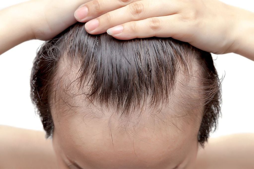 En los hombres, la pérdida de cabello puede dar como resultado una línea de pelo en forma de “M”. 