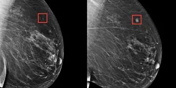 Detección cáncer de mama con IA