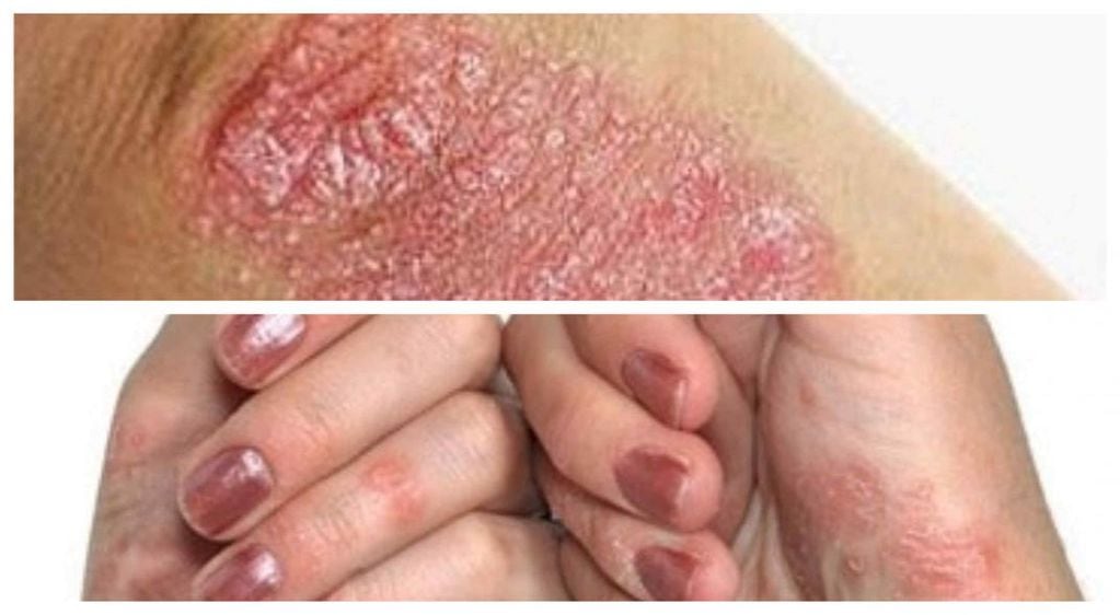 En algunos casos, la psoriasis puede afectar las uñas causando engrosamiento, desmoronamiento y cambios en la apariencia. 