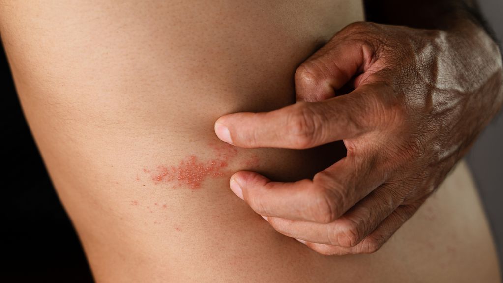 El herpes zóster, popularmente llamado culebrilla, es una infección viral que afecta a los nervios y la piel.