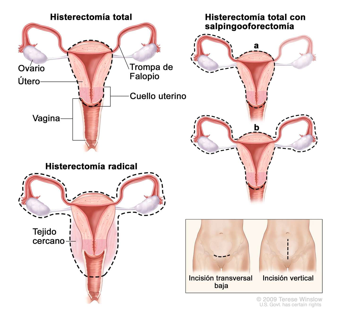 ¿Cómo se realiza una histerectomía? (Instituto Nacional del Cáncer de los Institutos Nacionales de la Salud de EE.UU.)  