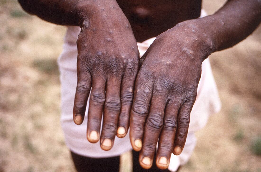 Esta imagen de 1997 fue proporcionada por los CDC durante una investigación sobre un brote de viruela del simio, que tuvo lugar en la República Democrática del Congo (RDC) - AP