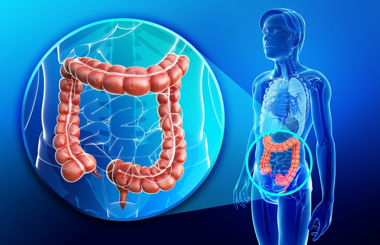 Cáncer colorrectal, el segundo cáncer de mayor mortalidad y el tercero más frecuente en Argentina.  