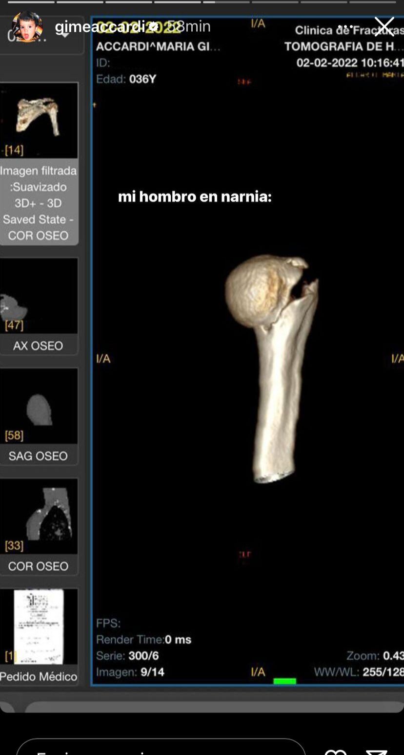 Impactantes imágenes de la multifractura de hombro que sufrió Gimena Accardi. Captura de historias.