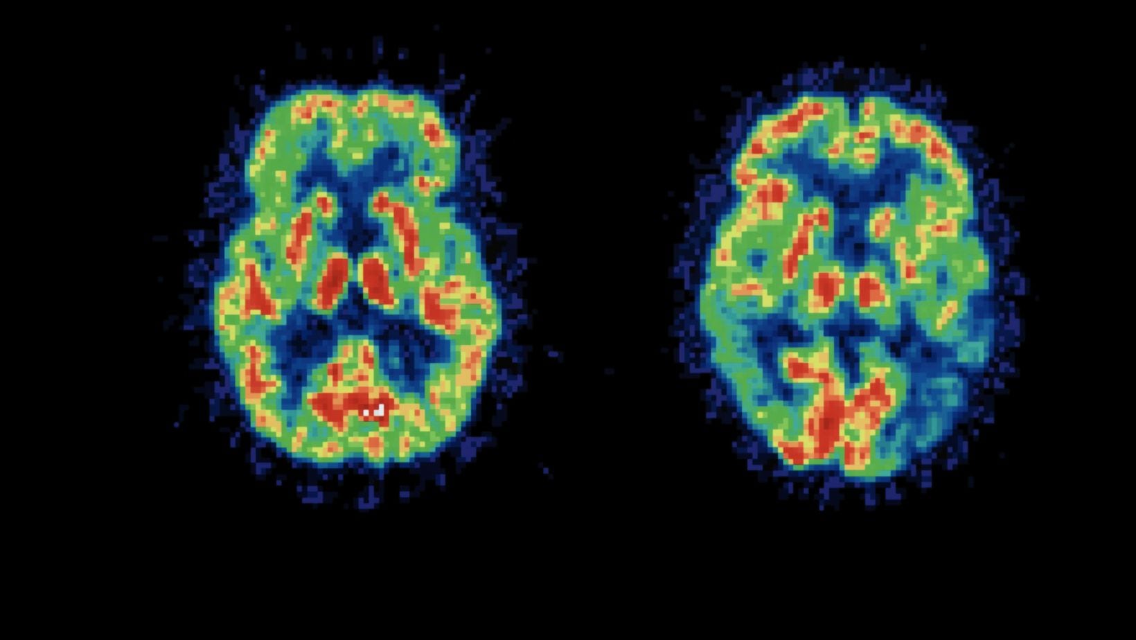 La investigación se basó en un modelo de IA que logró distinguir, con una precisión superior al 90%, los escáneres de actividad cerebral de hombres y mujeres.