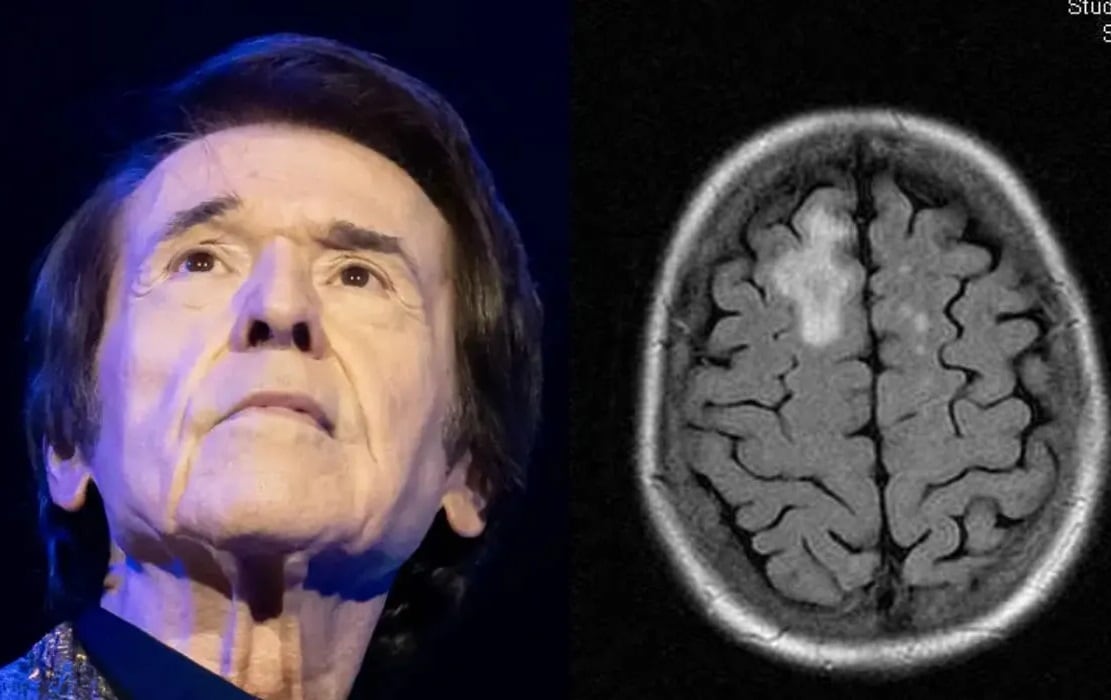 Linfoma cerebral: el diagnóstico para el cantante español Raphael