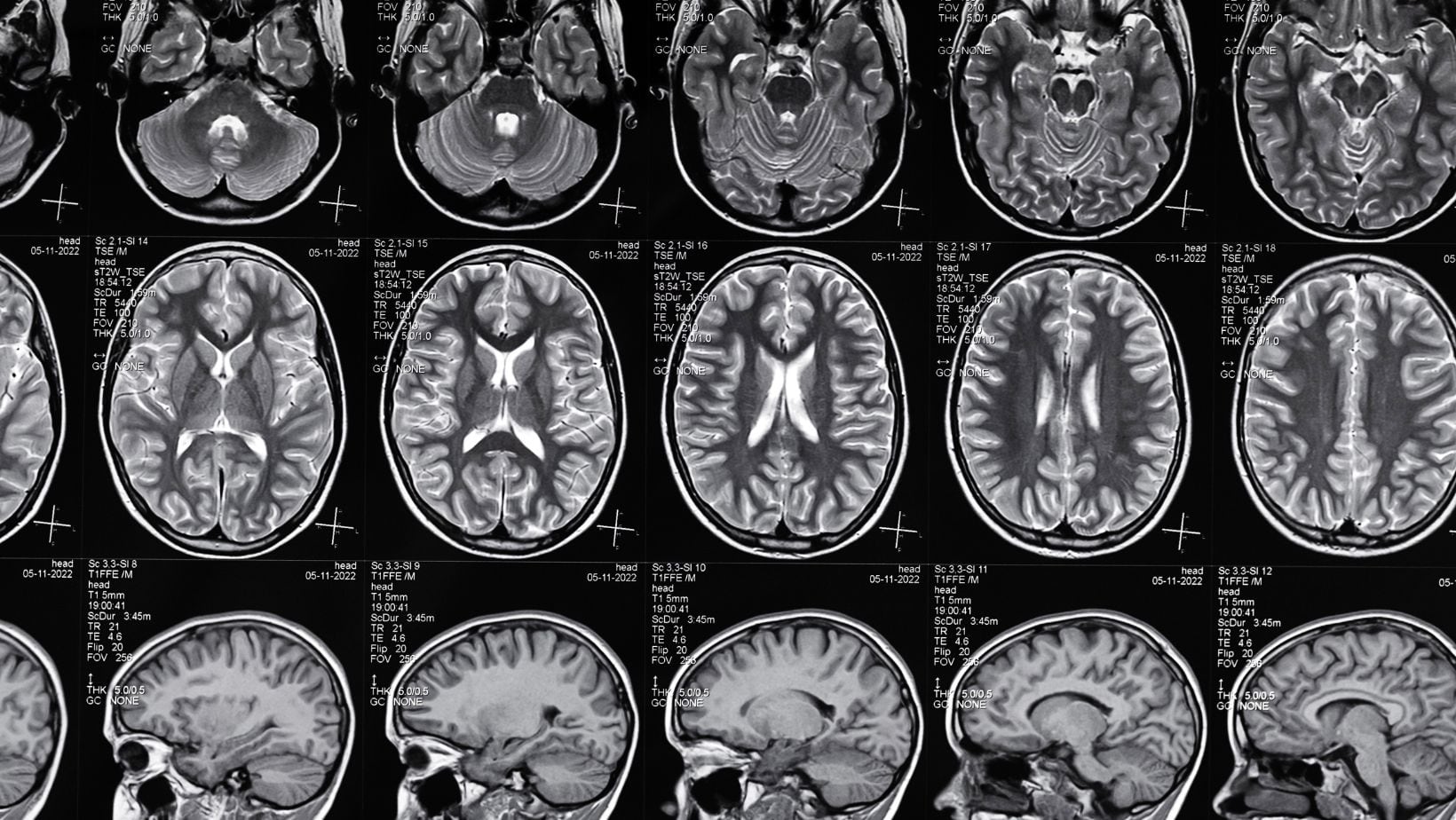 El modelo de IA, que se apoyó en una red neuronal profunda, identificó regiones cerebrales clave que diferenciaban los cerebros masculinos de los femeninos.