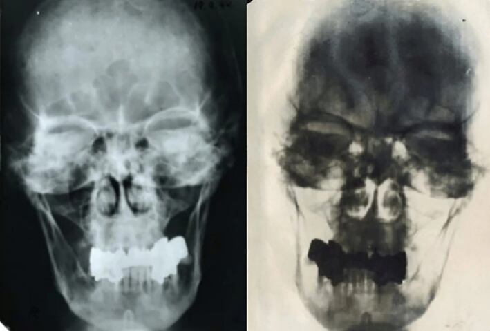 
Las radiografías que tomó el dentista de Adolf Hitler y que después permitieron comparar y certificar que la dentadura en poder de la KGB era del genocida (National History of Medicine).
