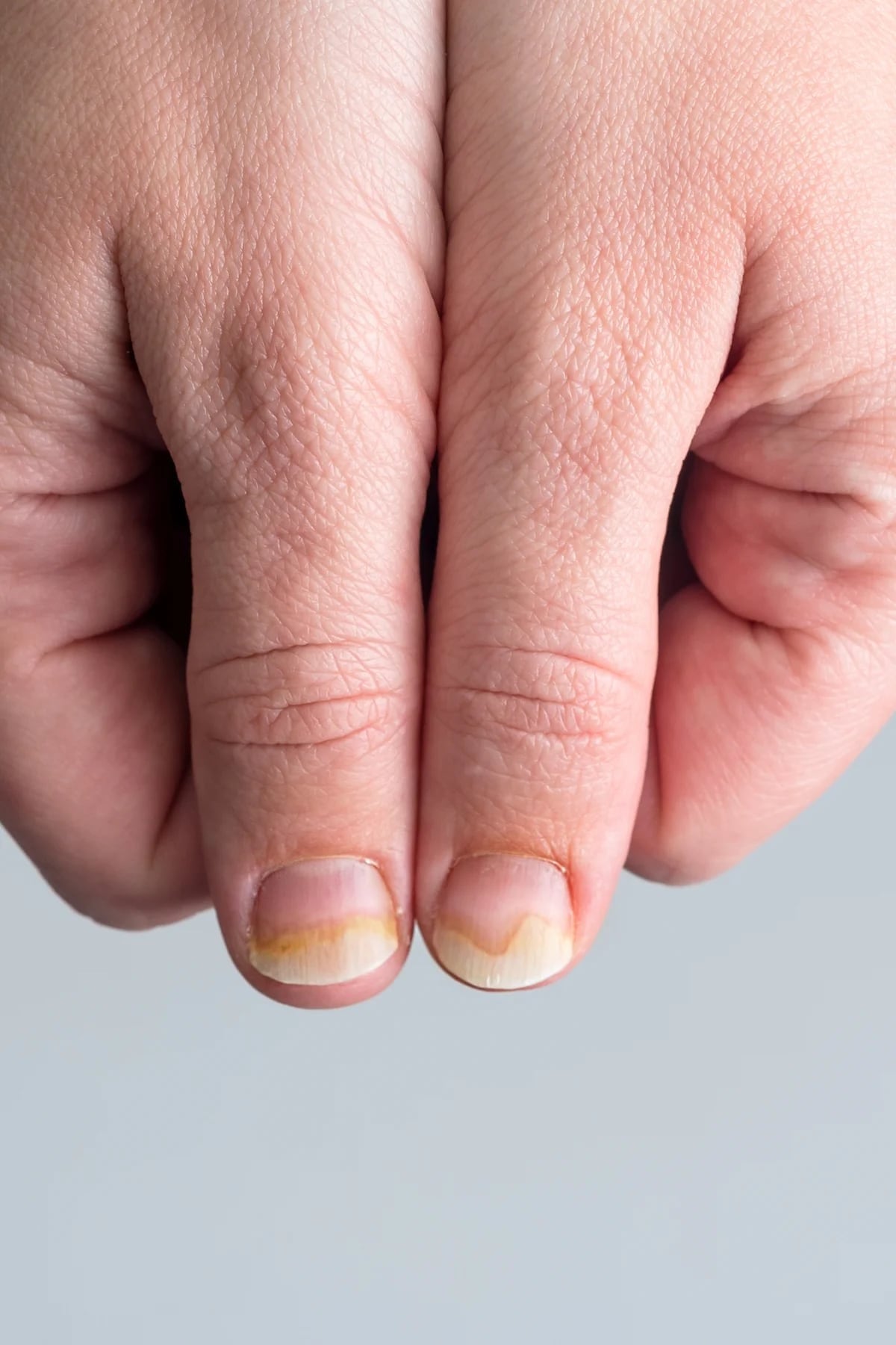 El remedio casero para quitar los hongos de las uñas.