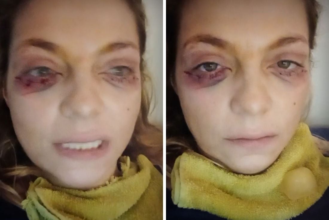 Tamara Paganini preocupó al mostrarse con marcas en su rostro, pero era por una cirugía estética.