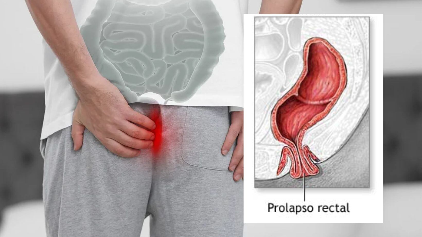 Prolapso rectal, una condición en la cual la fuerza en el área anal se debilita y el ano se descoloca.