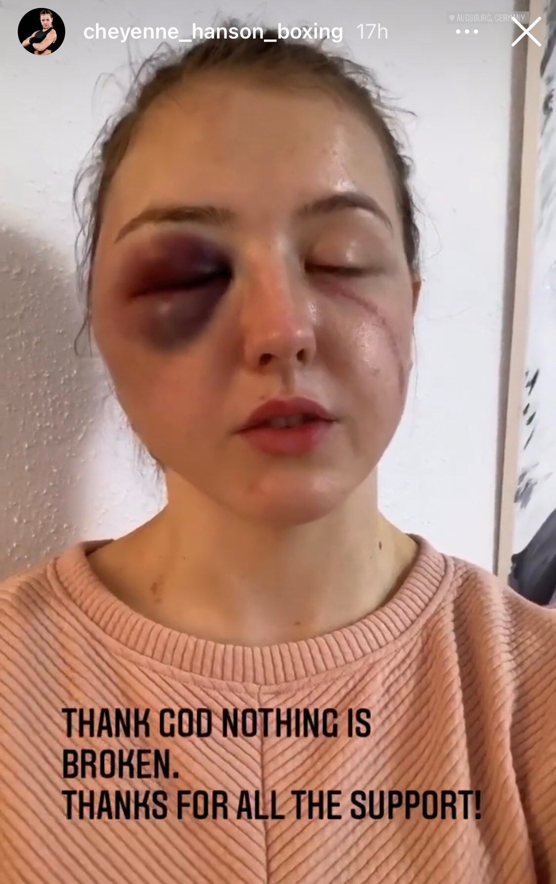 Cheyenne Hanson compartió en sus redes como le quedó el rostro después de la pelea. Foto: Instagram.