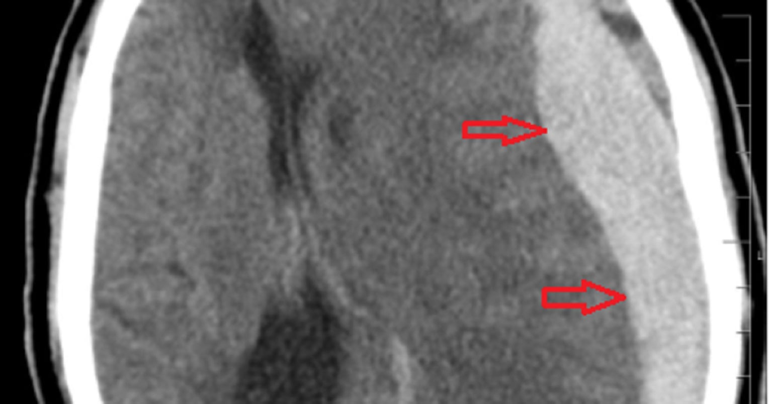 Qué es un hematoma subdural