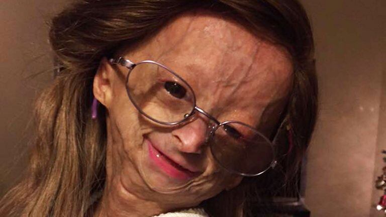 Adalia Rose, la joven con envejecimiento prematura reina de las redes sociales.