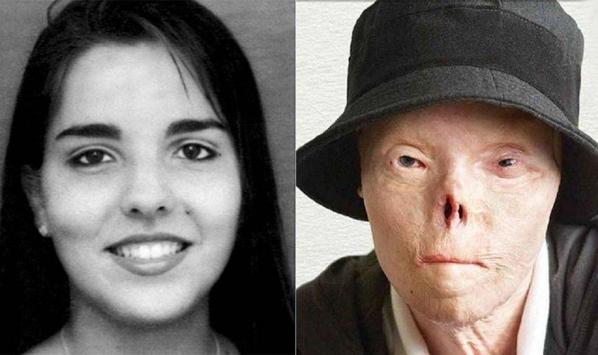 
En 1999, Jacqui sufrió quemaduras en el 60% de su cuerpo tras un accidente. | Web
   