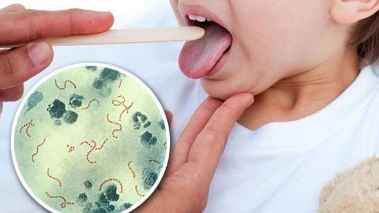 Cuáles son los síntomas del Streptococcus pyogenes