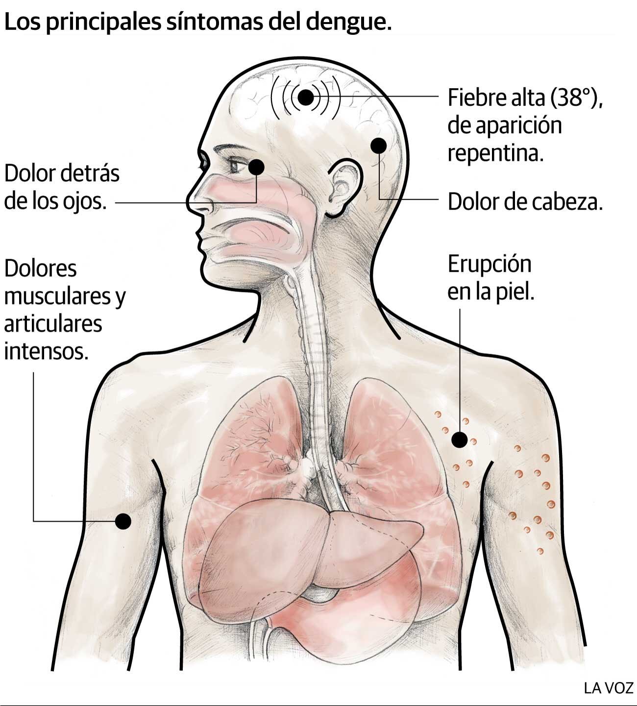 Infografía: Los principales síntomas del dengue. Infografía: La Voz