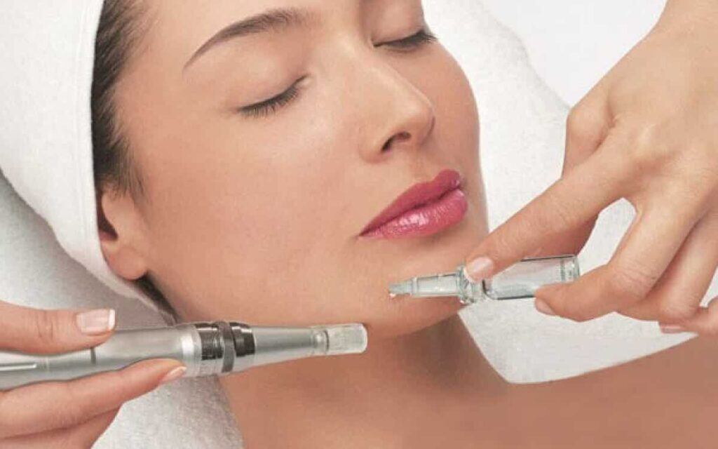 El microneedling se utiliza para tratar arrugas, cicatrices y texturas en la piel. 