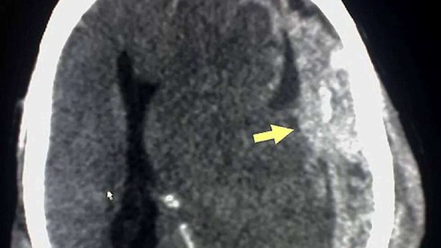 Qué es un hematoma subdural