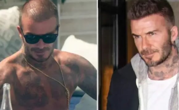 David Beckham y sus injertos de pelo