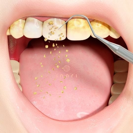 La inesperada infusión que ayuda a quitar el sarro de los dientes de forma natural