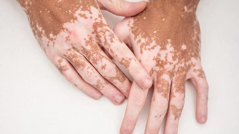 El principal síntoma del vitíligo es la aparición de manchas blancas o despigmentadas en la piel. 