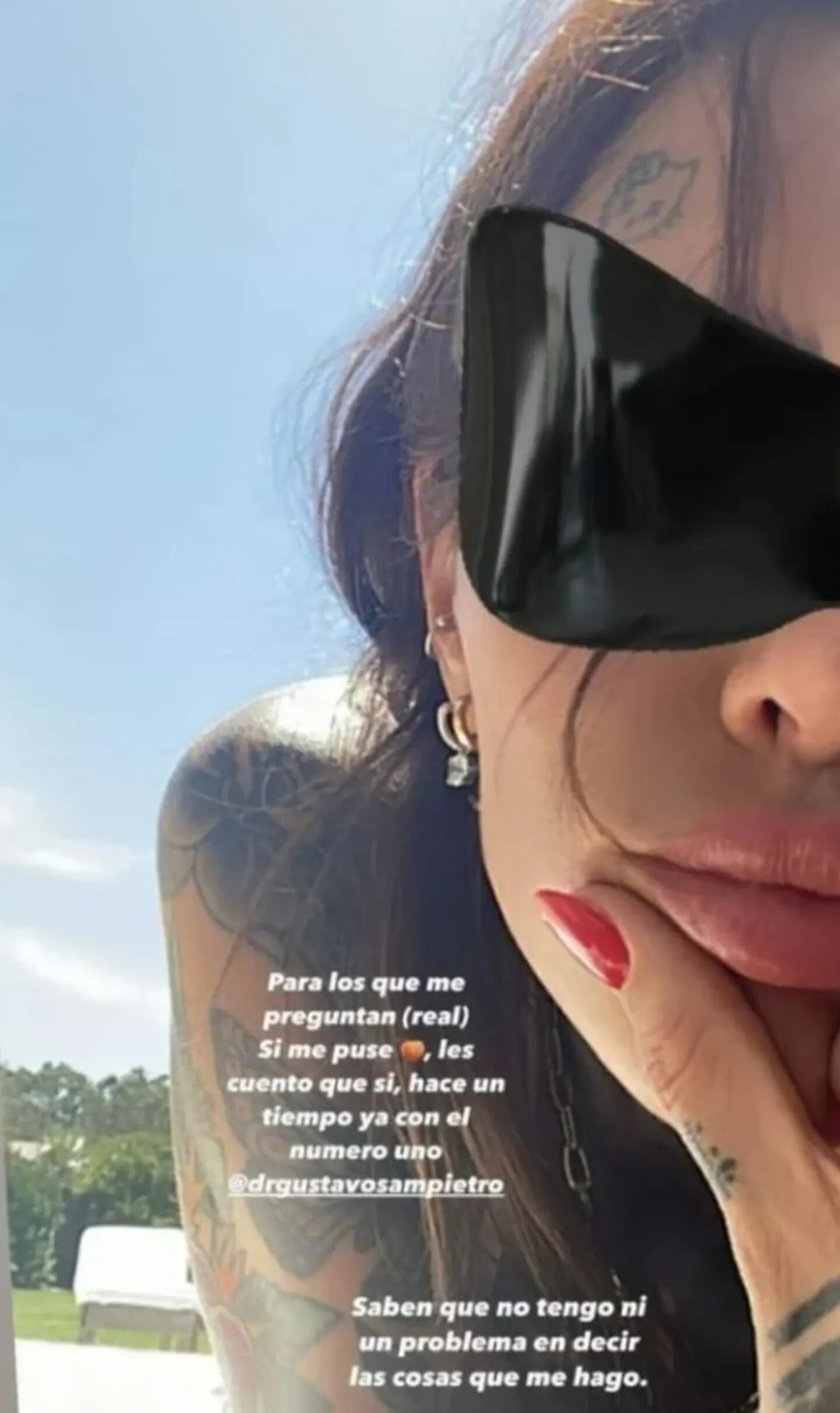 Cande Tinelli se sometió a una nueva cirugía estética y mostró en sus redes cómo le quedó.