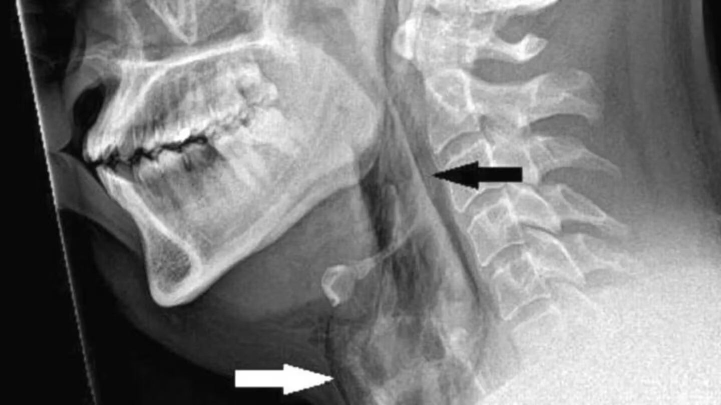 La radiografía reveló que se desgarró la tráquea. 