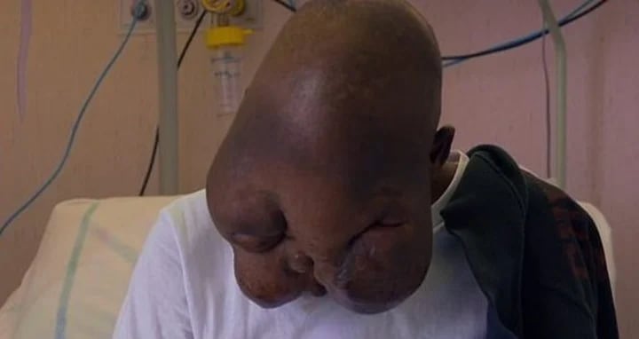 Un joven que tenía un tumor en su cabeza fue tratado y operado y pudo recuperar su vida.