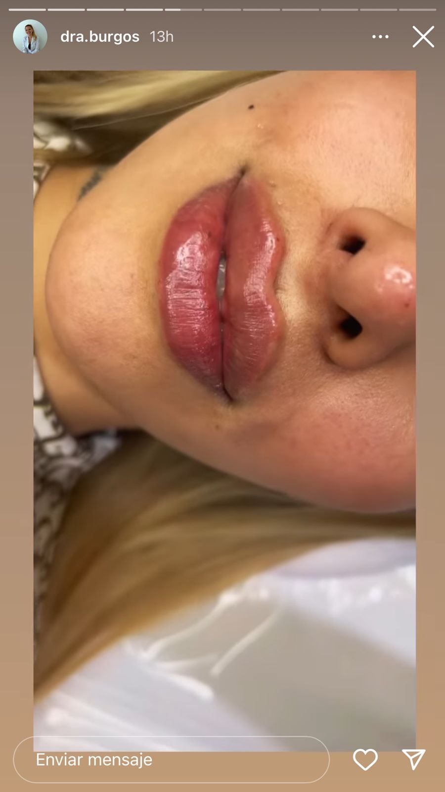 Tamra Báez se puso bótox en los labios para parecerse a sus muñecas preferidas.