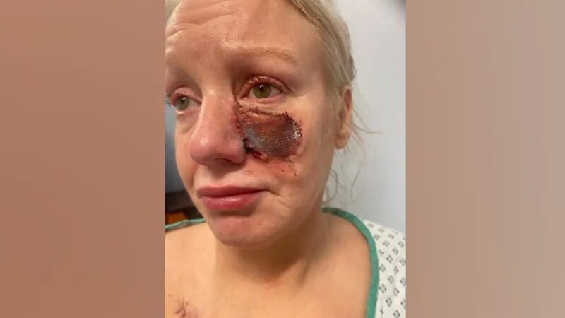 IMÁGENES SENSIBLES. Así quedó el rostro de Kelly Allen. Foto: BBC.