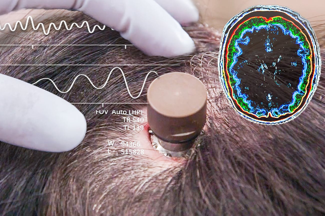 Elon Musk confirmó que Neuralink implantó un chip cerebral en un ser humano por primera vez. (Neuralink)