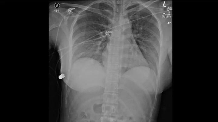 Le dispararon en el pecho, los implantes de silicona desviaron la bala y le salvó la vida.