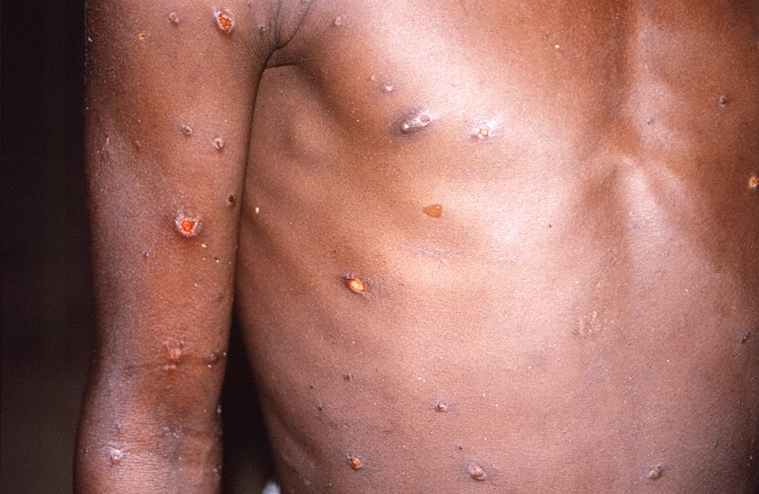 Esta imagen de 1997 proporcionada por los CDC muestra el brazo derecho y el torso de un paciente, cuya piel mostraba varias lesiones debido a lo que había sido un caso activo de viruela del simio. A medida que se detectan más casos de viruela del simio en Europa y América del Norte en 2022, algunos científicos que han monitoreado numerosos brotes en África dicen que están desconcertados por la propagación inusual de la enfermedad en los países desarrollados.