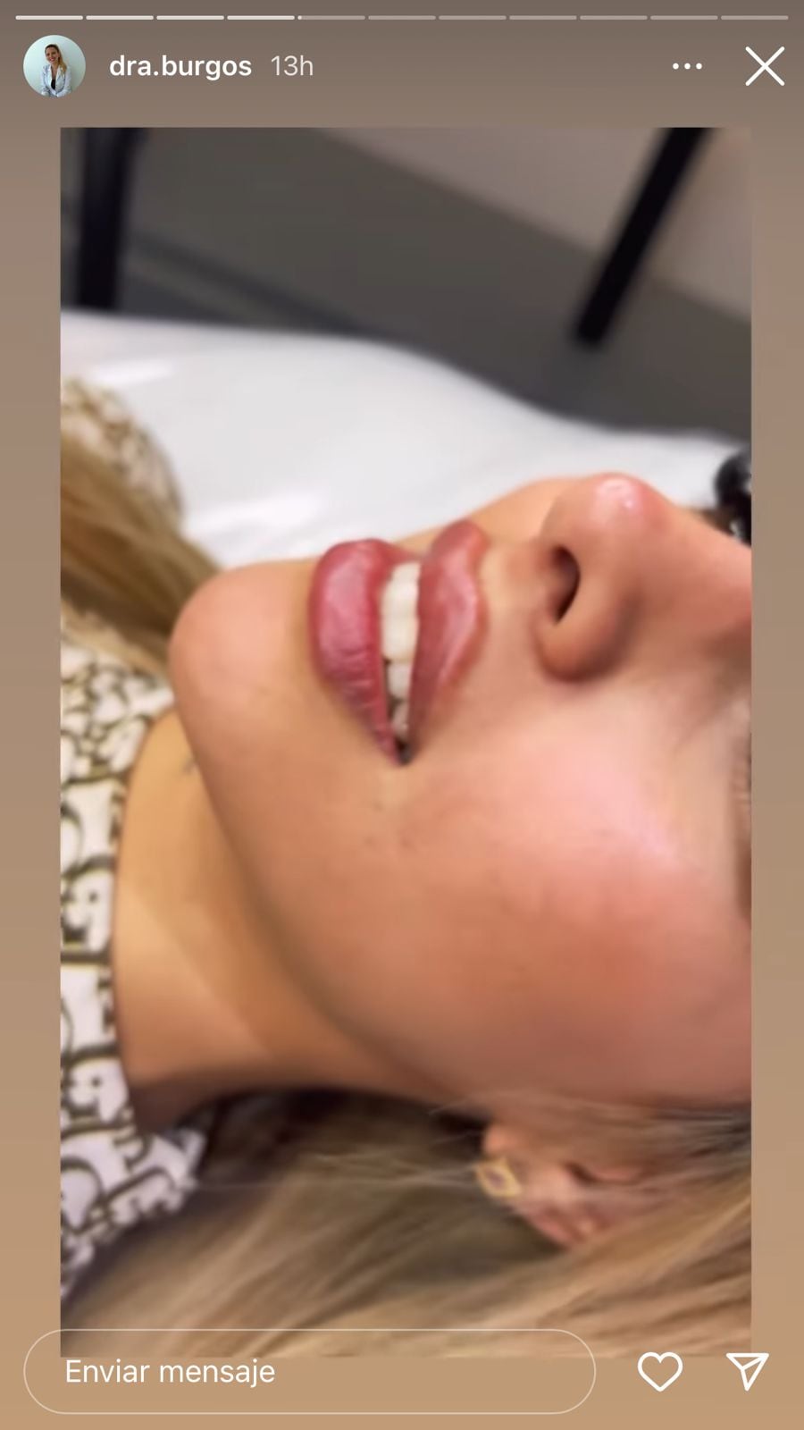 Tamra Báez se puso bótox en los labios para parecerse a sus muñecas preferidas.