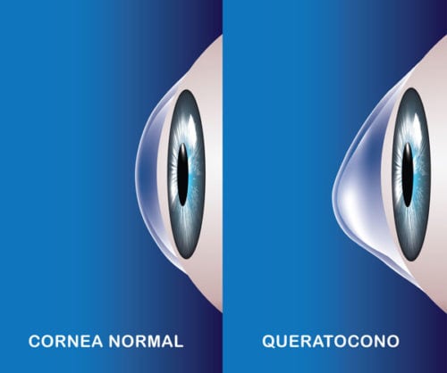 Cornea normal y queratocono.