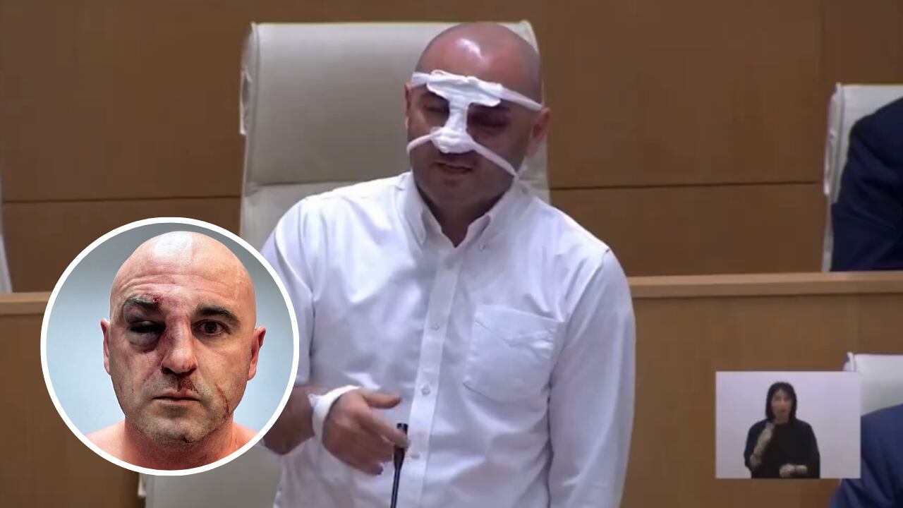 Levan Khabeishvili, líder del partido Movimiento Nacional Unido, sesionó con notables heridas ocasionadas por fuerzas policiales. 
 Foto: Redes Sociales.