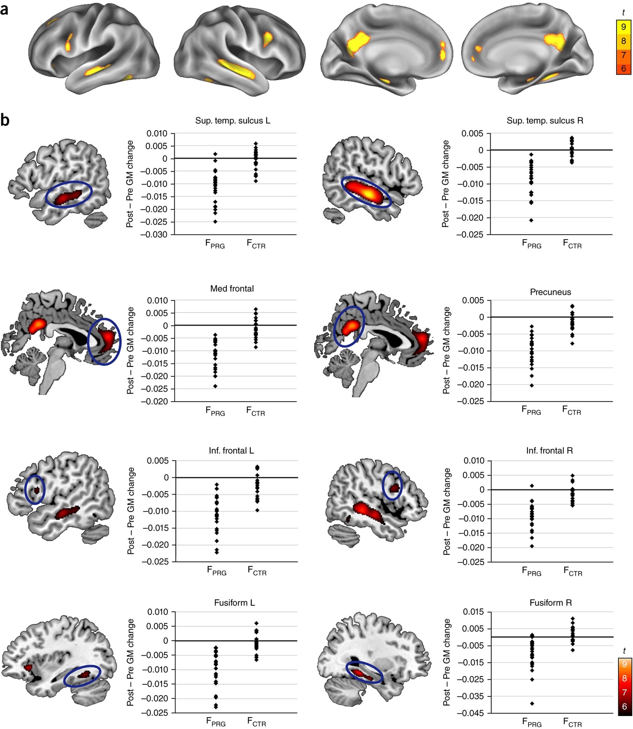 Este trabajo amplía el conocimiento sobre los cambios cerebrales durante el embarazo, destacando una reducción del volumen de materia gris y del grosor cortical en la novena semana de gestación.