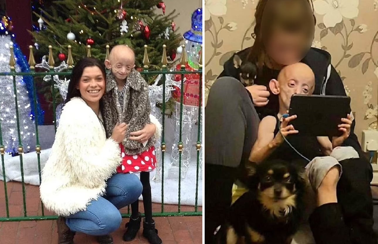 Ashanti Smith vivió con mucha alegría pese a la progeria, según su madre de 36 años - 