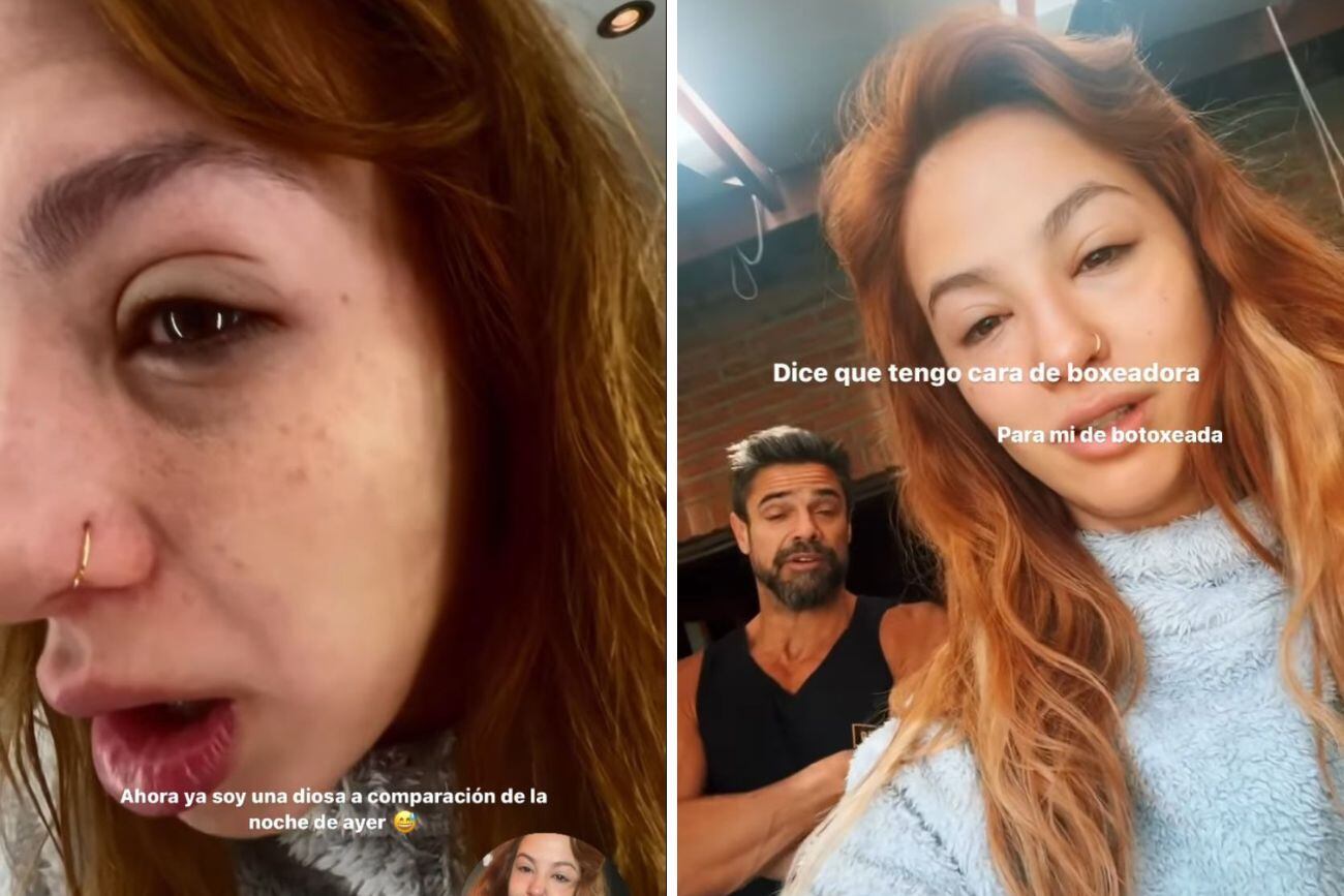 Flor Vigna preocupó al lucir irreconocible a causa de una alergia.