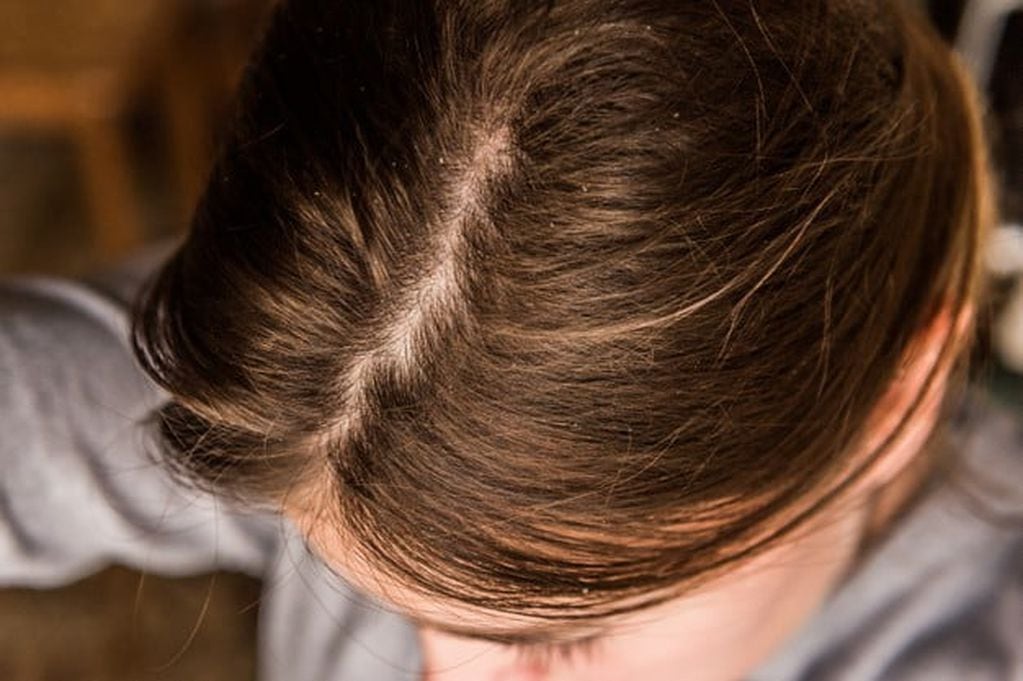 Para tratar el cuero cabelludo sensible, es importante identificar y evitar los desencadenantes que causan la sensibilidad. 